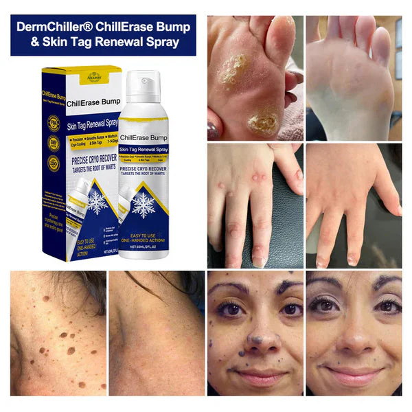 💥Alcuras® ChillErase Bump & Skin Tag Renewal Spray