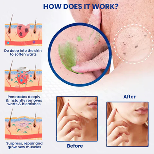 ✅ Official Store: Alcuras® NatureErase Instant Mole & Spot Cream